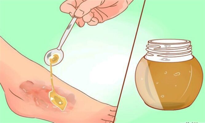 درمان زخم ها و جراحت ها با عسل کنار طبیعی | کارنیکا استور